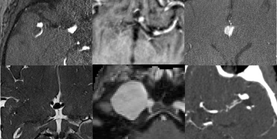 Kaggle Competition: RSNA Intracranial Aneurysm Detection